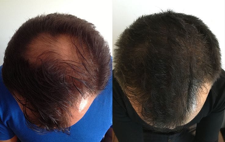 FullStrand Kerafix Pro – Instant Hair Building Fibres