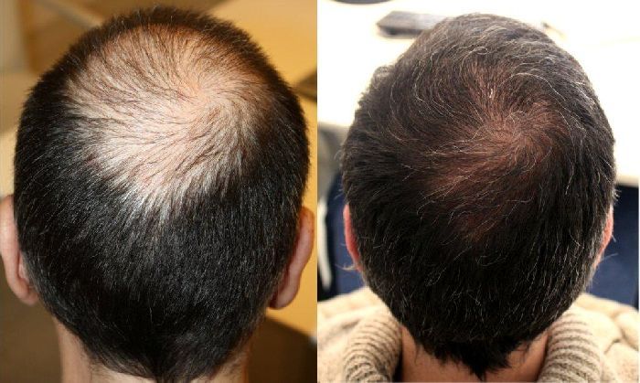 FullStrand Kerafix Pro – Instant Hair Building Fibres